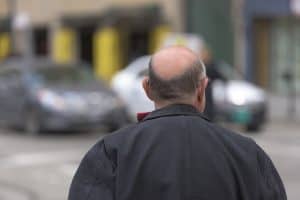 Scopri di più sull'articolo Trapianto capelli: cosa sapere?